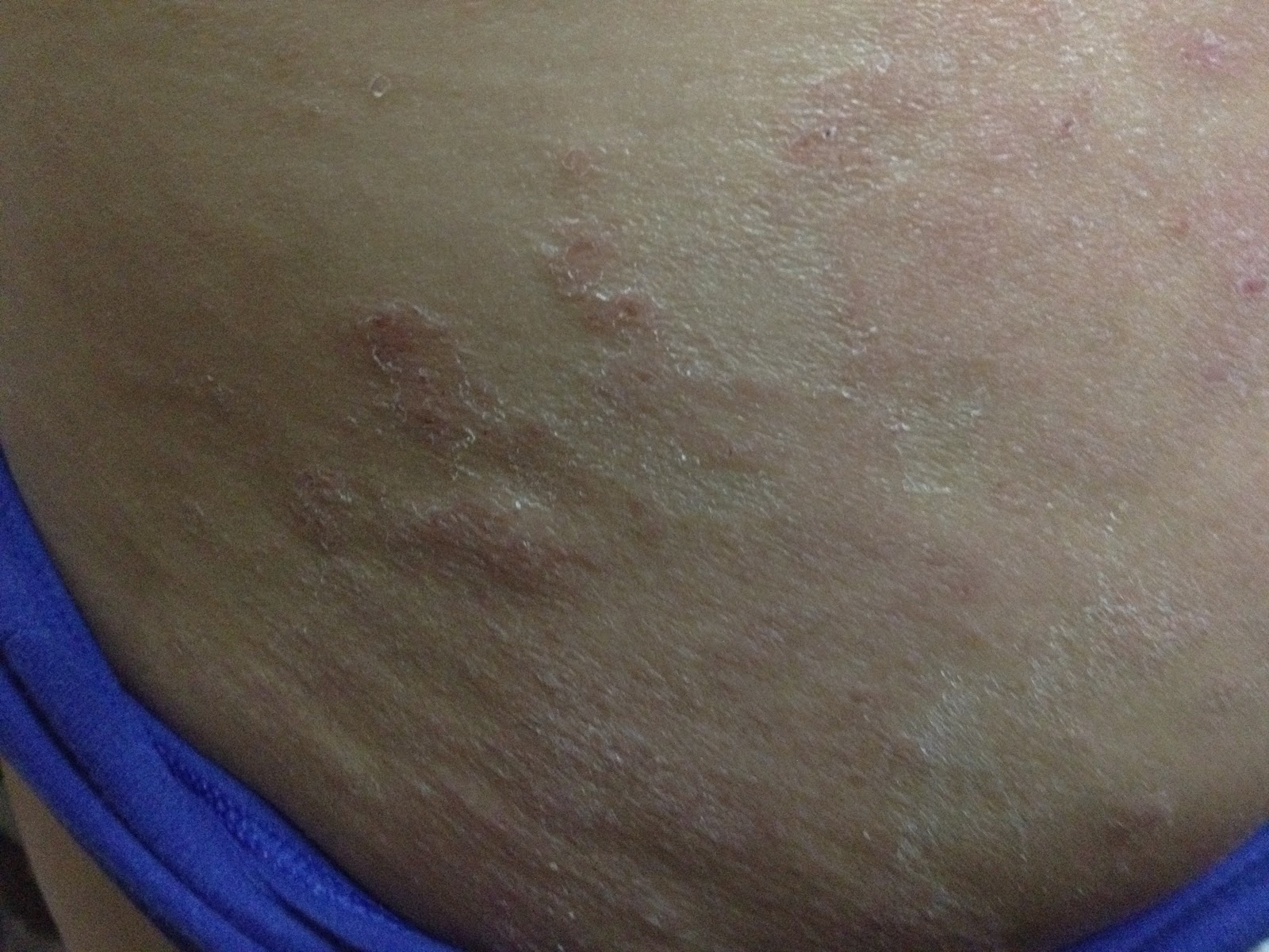 cough variant asthma Skin Asthma Diary Pictures